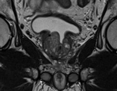 Urinary Morbidity in Men Treated With Stereotactic Body Radiation Therapy (SBRT) for Localized Prostate Cancer Following Transurethral Resection of the Prostate (TURP)